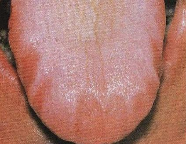 Large or Scalloped Tongue